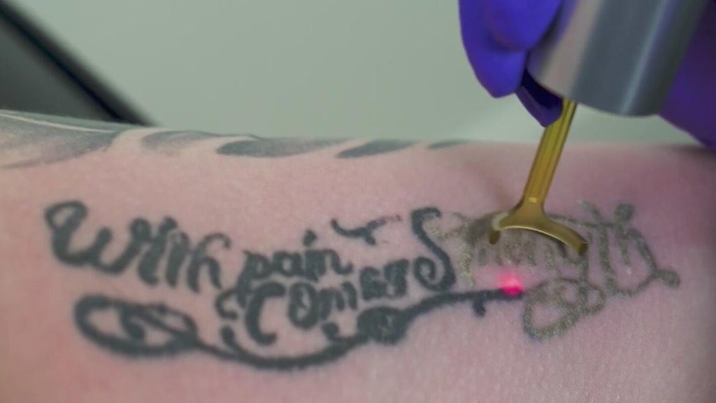 From exes' names to old designs, 30 to 40 South Florida clients a week pay to erase tattoos, clinic says — CBS Miami, Parkland Technology news